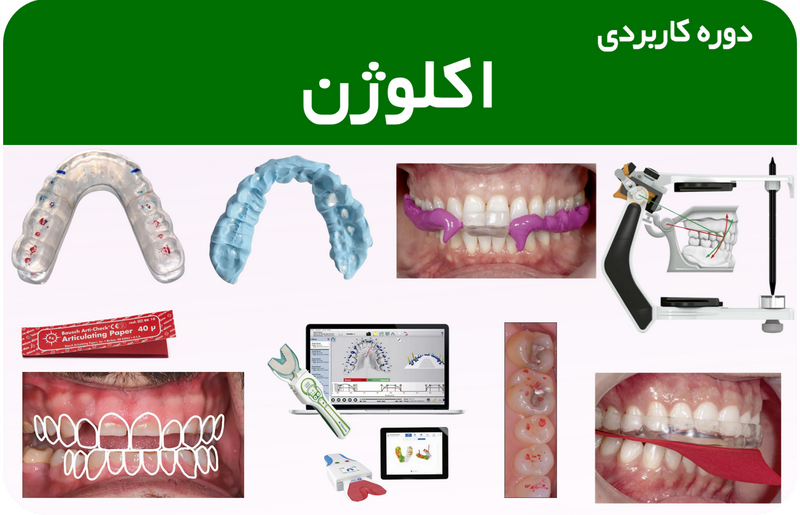 اکلوژن دندان و ایمپلنت